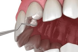 What to Expect During Chipped Tooth Treatment at a Dental Clinic in Rolla