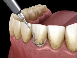Why Should Patients Entrust a Periodontist for Deep Teeth Cleaning
