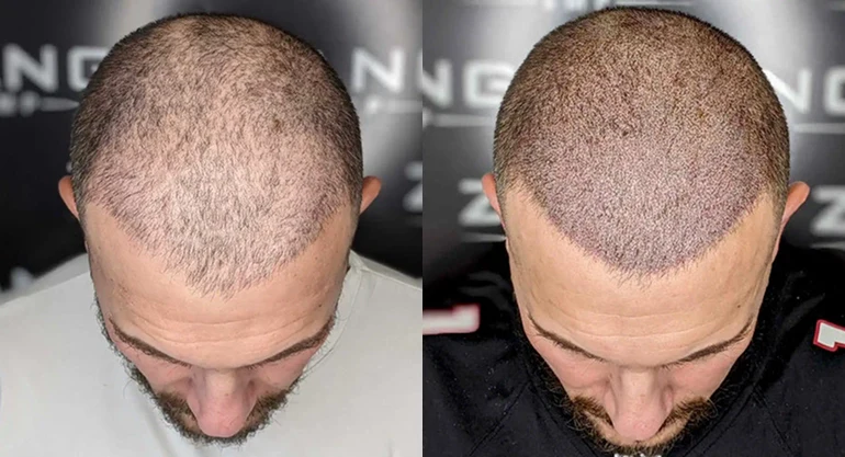 Confidence Restored Through Orange County Scalp Micropigmentation