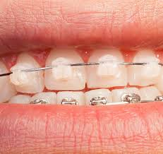 Benefits of Choosing Clear Braces in Las Vegas