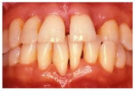 Severity of Periodontal Disease and the Role of Expert Dentists in Rolla